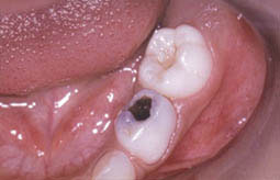 Fig. 5a : Secteur mandibulaire gauche. Carie occlusale sur 74. Petite lésion carieuse sur 75