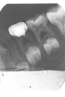 Fig. 5d : Radiographie de contrôle 18 mois après la pulpotomie et la pose de la coiffe pédodontique sur la 74.