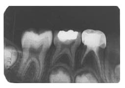 Fig. 8b : Radio de contrôle du secteur mandibulaire droit 18 mois après traitement. Noter l’absence de manifestations pathologiques suite aux traitements.