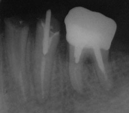 Fig 4 : Radiographie préoprératoire mettant en évidence la proximité entre la crête osseuse et la limite de la préparation.