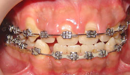 Fig 8 : Avant : hyperplasie gingivale persistante après motivation à l’hygiène bucco-dentaire et détartrage.