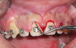 Fig 9 : Evaluation de la profondeur du sillon gingivo-dentaire