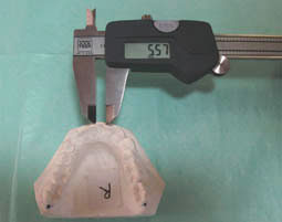 Fig 11: Mesure de l’espace nécessaire à l’aide d’un pied-à-coulisse numérique (somme des diamètres mésio-distaux des dix dents antérieures) (Service d’ODF, CCTD de Rabat)