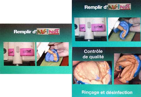 Fig 13 : La prise d’empreinte (14)