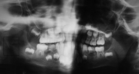 Fig 1 : Foyer ostéolytique irrégulier avec fracture sous condylienne basse. 