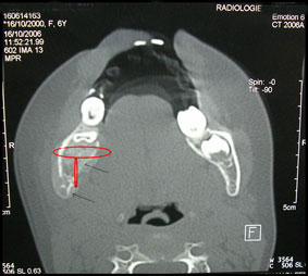 Fig 2 : Ostéolyse et décalcification de l’os spongieux.   