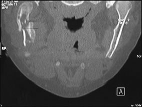 Fig 3 : Réaction périostée lamellaire. Fracture pathologique sous condylienne basse.