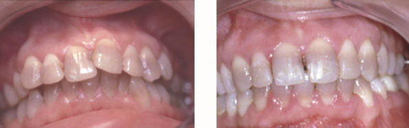 Fig. 10 et 11 : Cas de colorations tétracycliniques, avant et après traitement orthodontique.