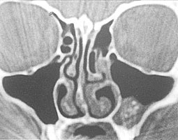 Fig 2 : Blondeau scanner montrant un corps étranger de tonalité métallique avec hypertrophie de la muqueuse du plancher sinusien. (Service O.R.L)