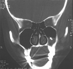 Fig 3 :  Blondeau scanner mettant en évidence une réaction “ en motte ” du plancher sinusien autour de formations hyperdenses punctiformes. (Service O.R.L) 