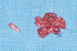 Fig 4 :  Corps étranger extrait correspondant à un apex dentaire et débris muqueux inflammatoires hypertrophiques. (Service O.R.L)