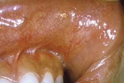 fig.9 : Vue clinique à 6 mois post-opératoires