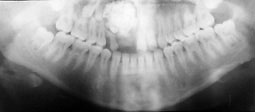 Fig 6 : Odontome complexe