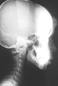 Fig 3 : Inclusion d’une centrale maxillaire en situation vestibulaire. Les rapports dans le sens transversal ne peuvent être déterminés qu’avec une incidence frontale ou axiale (service d’ODF). 