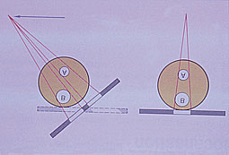 Fig 4 : représentation schématique de la technique d’Ewan et Clark (Pasler)