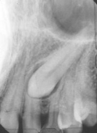 Fig 6 :  Rétro-alvéolaires d’une canine incluse.  Sa position palatine est confirmée par le déplacement de la dent dans le sens de la source radiologique (Service d’ODF).