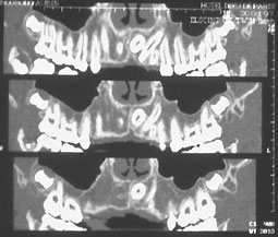 Fig 9 : Coupes de scanner montrant l’inclusion d’une canine avec ses rapports (Service d’ODF). 