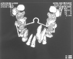 Fig 10 : Reconstruction tridimensionnelle montrant l’inclusion d’une canine en  transposition avec la latérale avec rétention de la 21 (Service d’ODF).