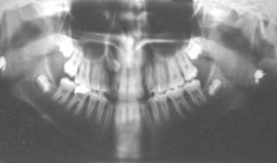 Fig 2 : Panoramique présentant l’inclusion des deux canines maxillaires. La canine de gauche étant de petite taille et floue sa situation est vestibulaire, par contre sa controlatérale en situation palatine est floue et agrandie par rapport aux  dents voisines (Service d’ODF). 