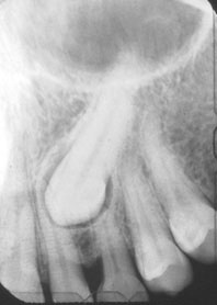 Fig 6 :  Rétro-alvéolaires d’une canine incluse.  Sa position palatine est confirmée par le déplacement de la dent dans le sens de la source radiologique (Service d’ODF).