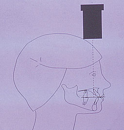 Fig 7 : 7a Représentation schématique d’une incidence ortho-occlusale maxillaire (Foucart)
