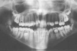 Fig 1 : Radiographie panoramique correctement prise avec un plan palatin horizontal.