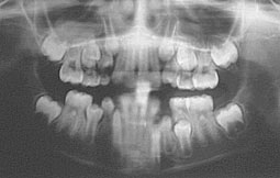 Fig 10 : Image en bouquet de fleur des secteurs latéraux maxillaires témoignant de la présence d’une dysharmonie dento-maxillaire.