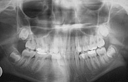 Fig 3 : Radiographie panoramique : la 44 en position ectopique, elle n’apparaît pas sur le cliché panoramique ( situation en dehors du plan de coupe