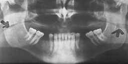 Fig 6 : projection de l’image du dos de la langue et du voile du palais pouvant simuler un trait de fracture de l’angle mandibulaire.