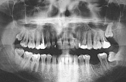 Fig 7 : hyperclarté de la branche horizontale de mandibule en regard de la loge mandibulaire.