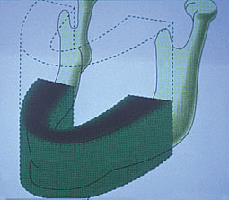 Fig 2 : épaisseur de coupe prédéterminée par le fabricant au niveau mandibulaire.