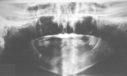 Fig 6 : projection de l’image du dos de la langue et du voile du palais pouvant simuler un trait de fracture de l’angle mandibulaire.