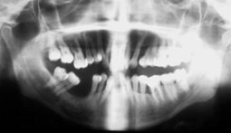 Fig 9 : évaluation des lésions parodontales sur un cliché panoramique.