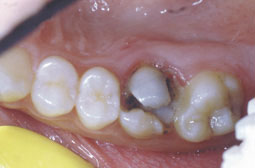 Fig.1a : situation clinique en pré-opératoire Destruction  coronaire de la 26