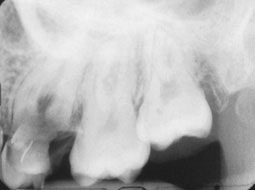 Fig. 2a : état radiologique en préopératoire : atteinte de la furcation de la 26