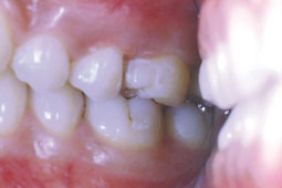 Fig. 7 : situation clinique après 6mois : Noter les bons contacts occlusaux et proximaux