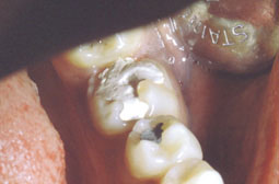 Fig. 2 : 46 avec une cavité mutilante chez une jeune  patiente .
