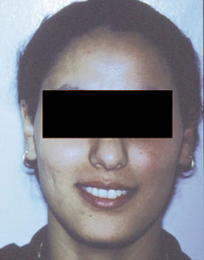Fig. 1a :  la patiente en début de traitement (face)