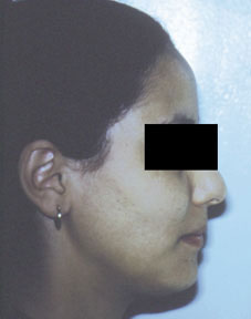 Fig. 1b :  la patiente en début de traitement (profile)