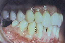 Fig.2a : occlusion latérale 