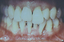 Fig. 2 : b - chevauchement dentaire avec égression de 11 et 22 avec récession 
