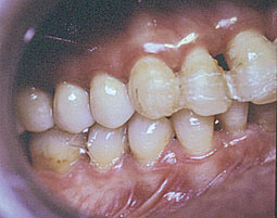 Fig. 2a : occlusion latérale droite 