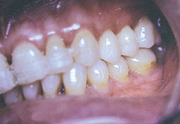 Fig. 2 : c - occlusion latérale gauche 