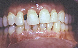 Fig. 3 : b - contention vestibulaire réalisée par le  parodontiste