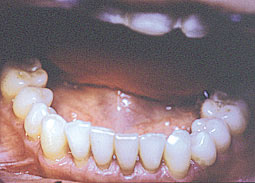 Fig. 3 : c- l'arcade inférieure avec un alignement acceptable 