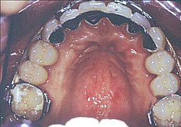 Fig. 4a : contention définitive toujours réalisée avant la dépose de l'appareil orthodontique