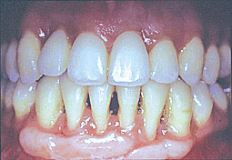 Fig. 4b : fin de traitement : correction des égressions et du chevauchement incisif avec une réattache gingivale permettant le traitement des récessions 