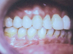 Fig. 5 : a - occlusion latérale 