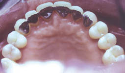 Fig. 6 :  contention définitive (attelle collée de canine à canine) réalisée avant la dépose de l'appareillage  orthodontique 