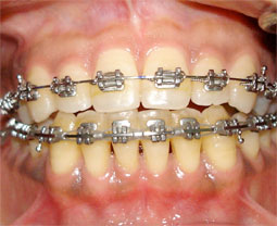 Fig 12 : En cours de traitement orthodontique : amélioration de l’environnement dento-gingival 